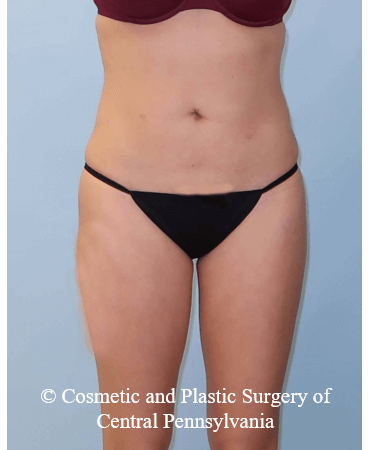 Brazilian Butt Lift ( BBL ) After