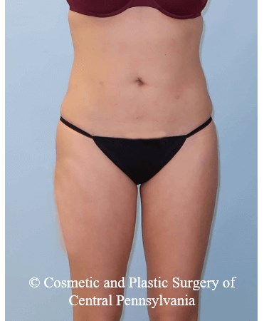 Brazilian Butt Lift ( BBL ) After