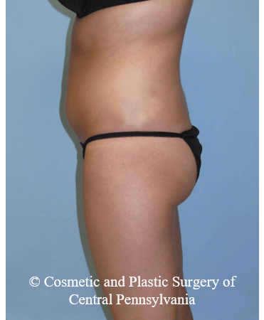 Brazilian Butt Lift Before