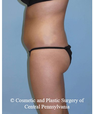 Brazilian Butt Lift Before