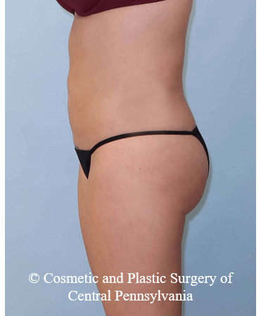 Brazilian Butt Lift After