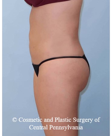 Brazilian Butt Lift After