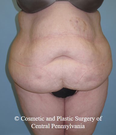 Panniculectomy Before