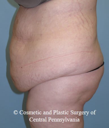 Panniculectomy Before