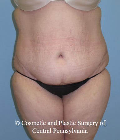 Panniculectomy After