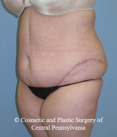 Tummy Tuck vs Panniculectomy - Halifax, NS - Prince Edward Island