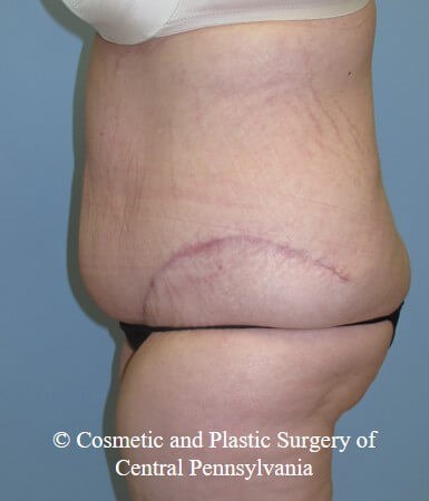 Panniculectomy After