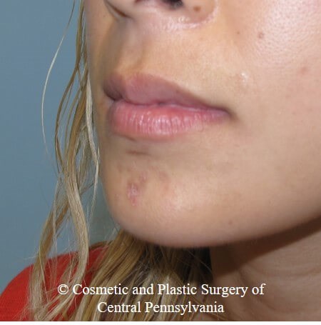 Juvederm Vobella lip filler Before