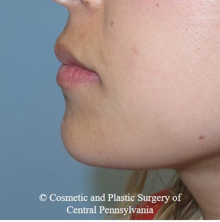 Juvederm Vobella lip filler Before