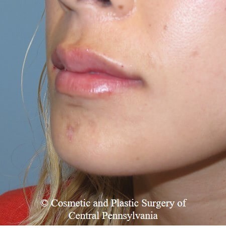 Juvederm Vobella lip filler After