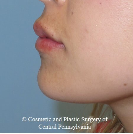 Juvederm Vobella lip filler After