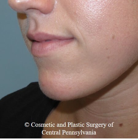 Juvederm Vobella for the lips Before