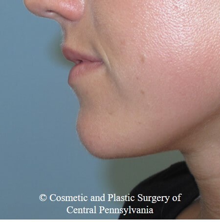 Juvederm Vobella for the lips Before