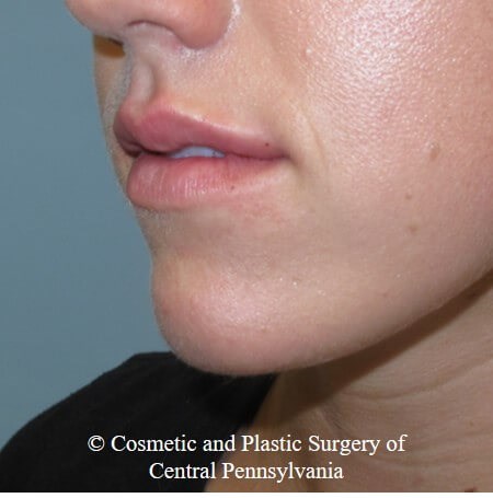 Juvederm Vobella for the lips After