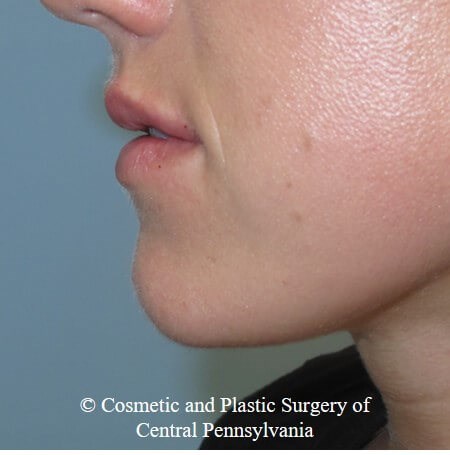 Juvederm Vobella for the lips After