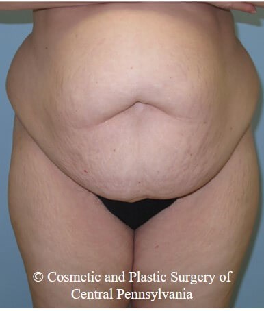 Abdominoplasty (Tummy Tuck) Before