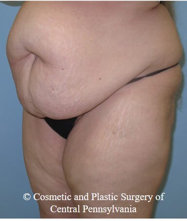 Abdominoplasty (Tummy Tuck) Before