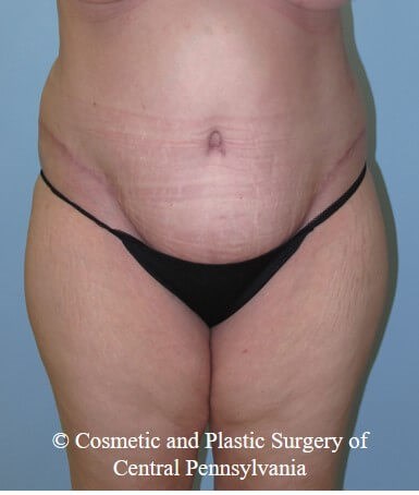 Abdominoplasty (Tummy Tuck) After