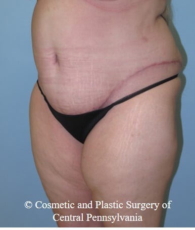 Abdominoplasty (Tummy Tuck) After