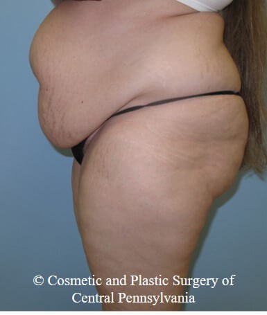 Abdominoplasty (Tummy Tuck) Before