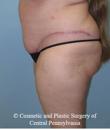 Abdominoplasty (Tummy Tuck) After