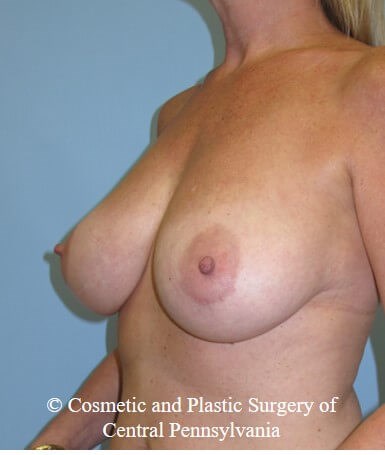 Breast Lift (Mastopexy) Before