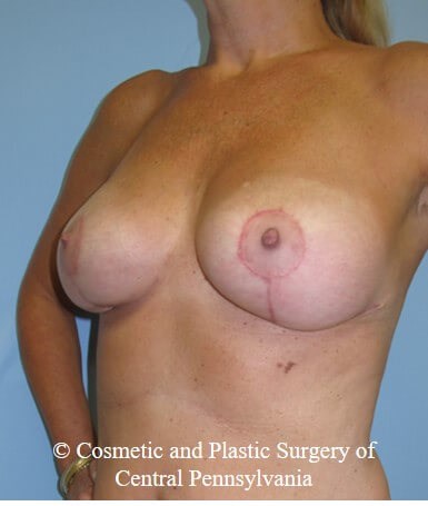 Breast Lift (Mastopexy) After