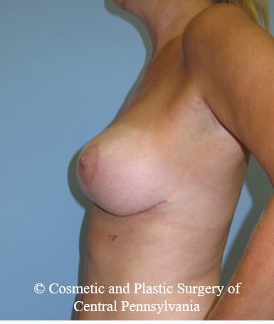 Breast Lift (Mastopexy) After