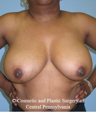 Breast Reduction Before