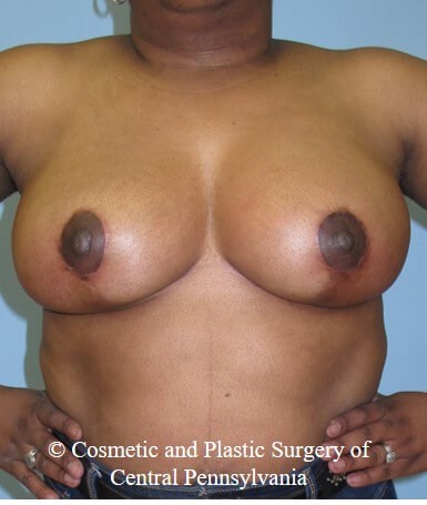 Breast Reduction After