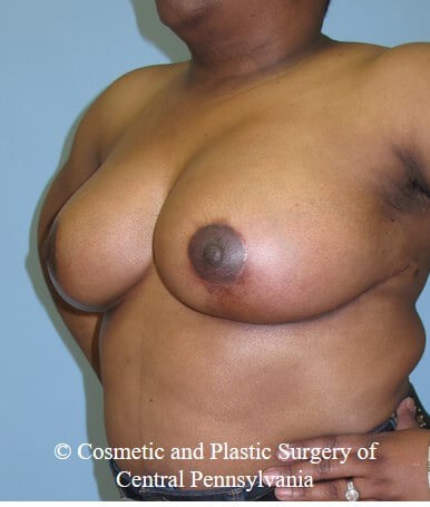Breast Reduction After