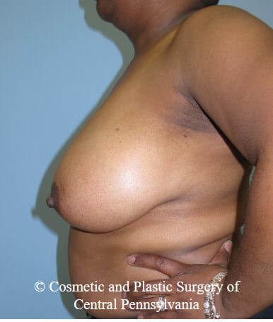 Breast Reduction Before