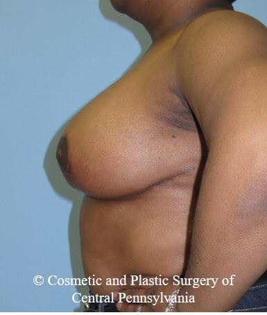 Breast Reduction After