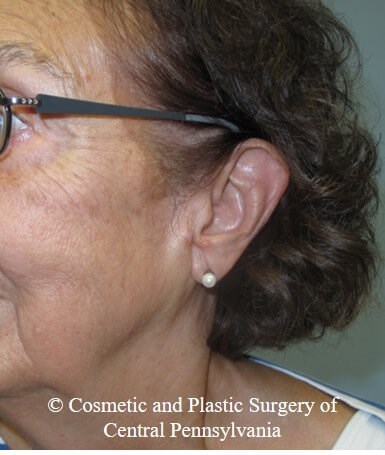 Vollure - ear lobule filler Before