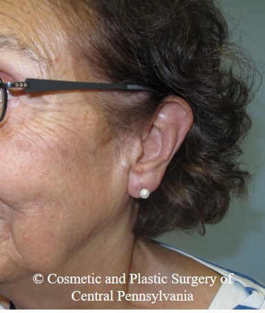 Vollure - ear lobule filler After