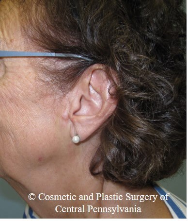 Vollure - ear lobule filler Before