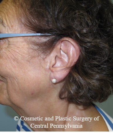 Vollure - ear lobule filler After