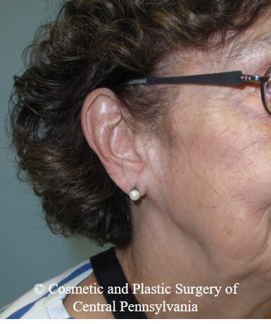 Vollure - ear lobule filler Before