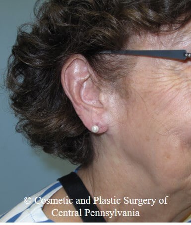Vollure - ear lobule filler After