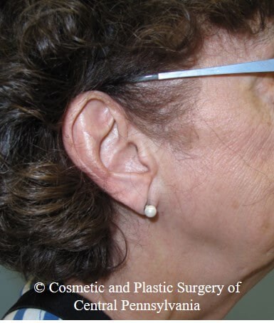 Vollure - ear lobule filler Before