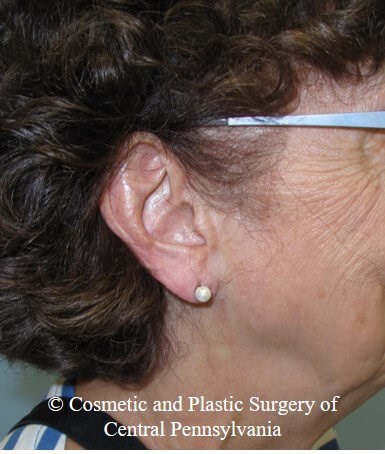 Vollure - ear lobule filler After