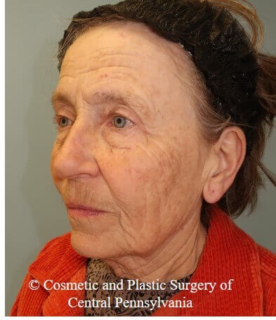 35% TCA Peel Before