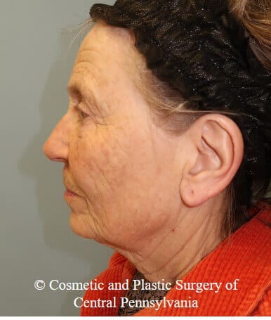 35% TCA Peel Before