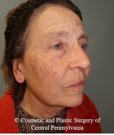 35% TCA Peel Before