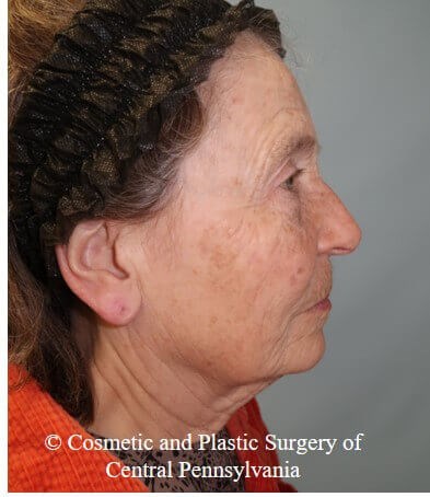 35% TCA Peel Before