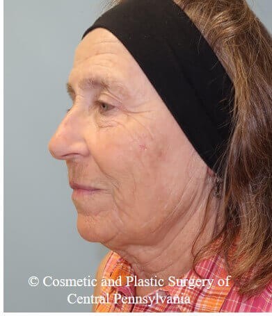 35% TCA Peel After