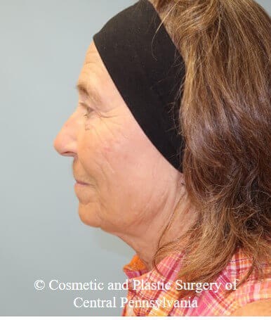 35% TCA Peel After