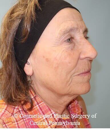 35% TCA Peel After