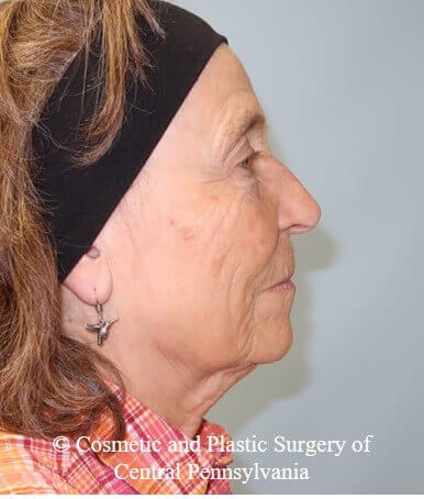 35% TCA Peel After