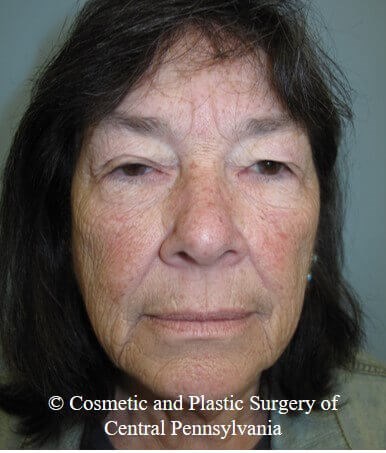 Blepharoplasty Before